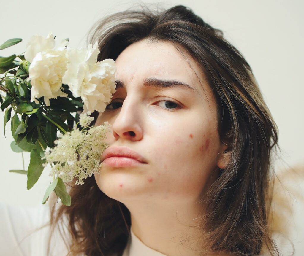 How To Remove Pimple Marks Natural Methods To Remove Cult Vogue how-to-remove-pimple-marks-natural-methods-to-remove-cult-vogue