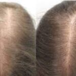 Minoxidil Results: When Can You See Them?