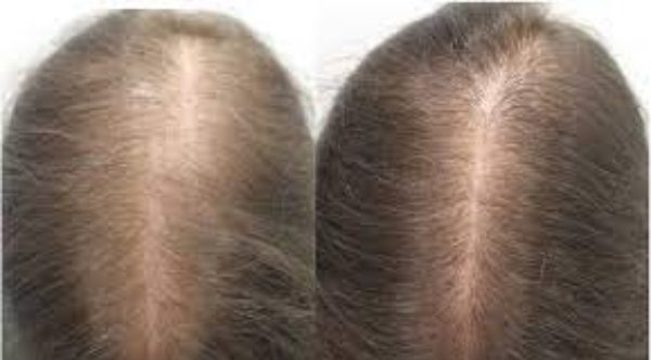 Minoxidil Results: When Can You See Them?
