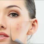 10 Home Remedies To Get Rid Of Pimples Quickly And Permanently