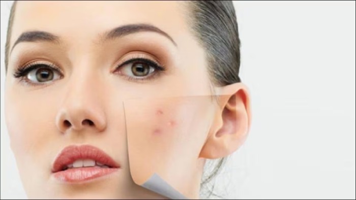 10 Home Remedies To Get Rid Of Pimples Quickly And Permanently