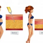 All You Need to Know About Liposuction Results Week by Week