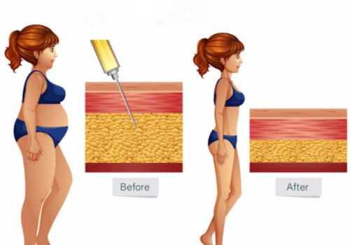 All You Need to Know About Liposuction Results Week by Week