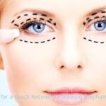 Advice for a Quick Recovery Following Blepharoplasty
