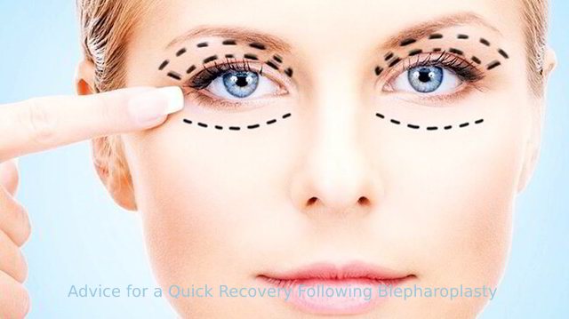 Advice for a Quick Recovery Following Blepharoplasty