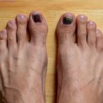 How to Treat Black Toenail Fungus