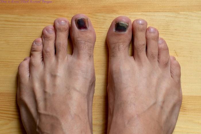 How to Treat Black Toenail Fungus